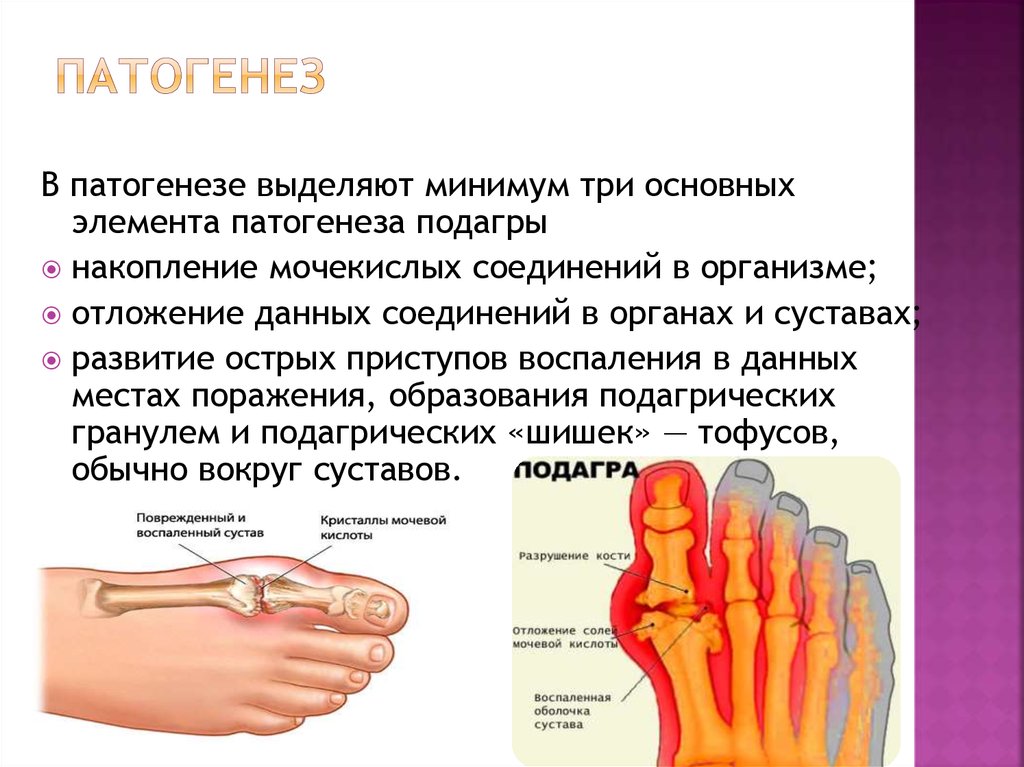 Заболевания подагра симптомы и причины