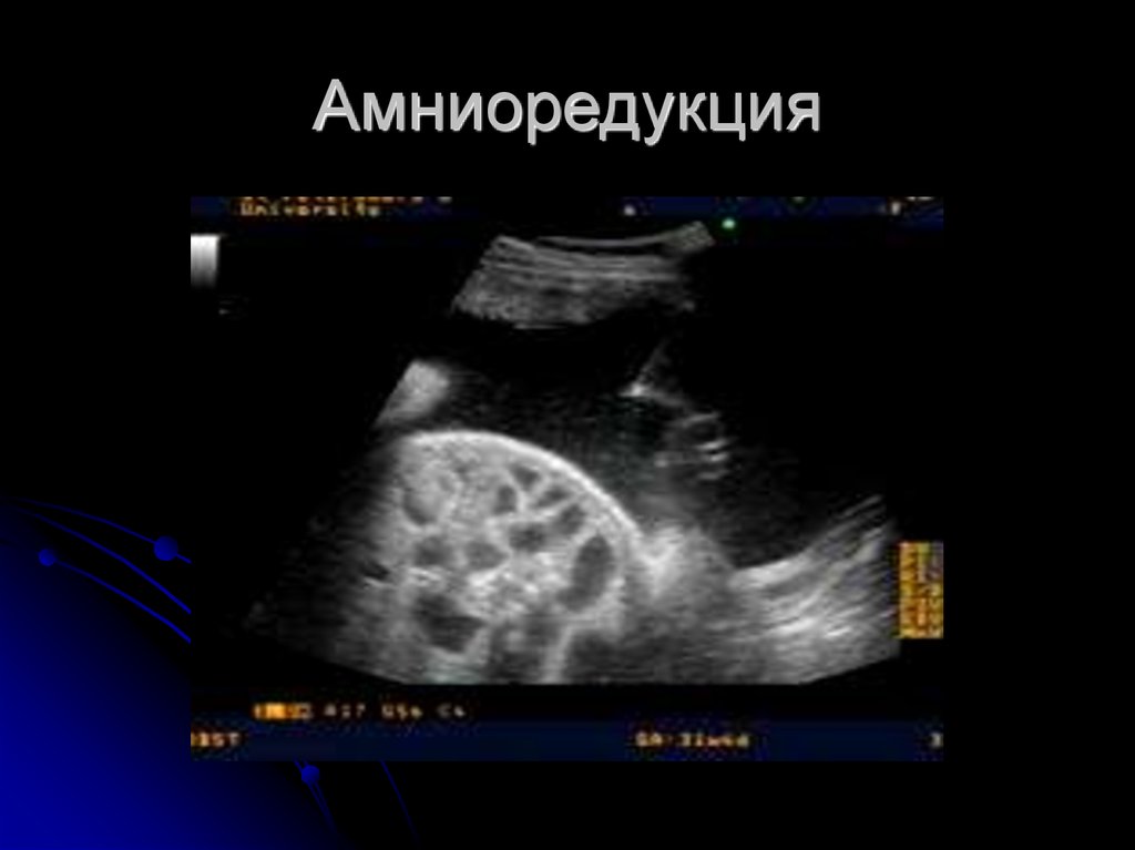 Амниоредукция