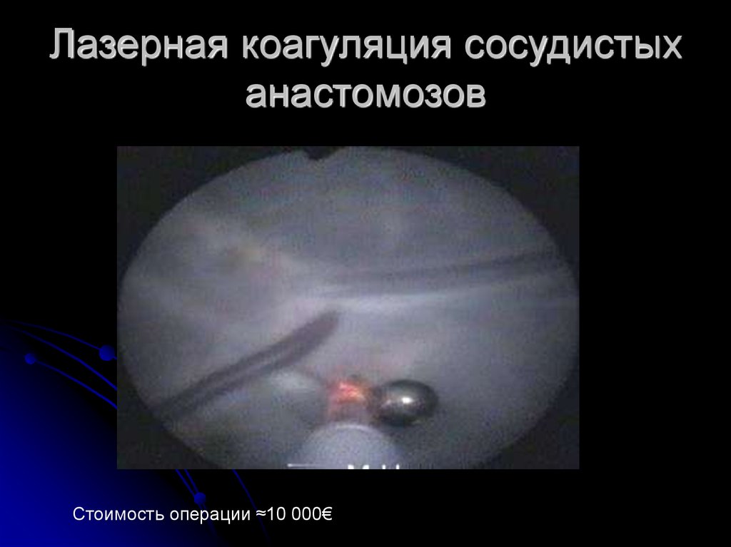 Лазерная коагуляция сосудистых анастомозов