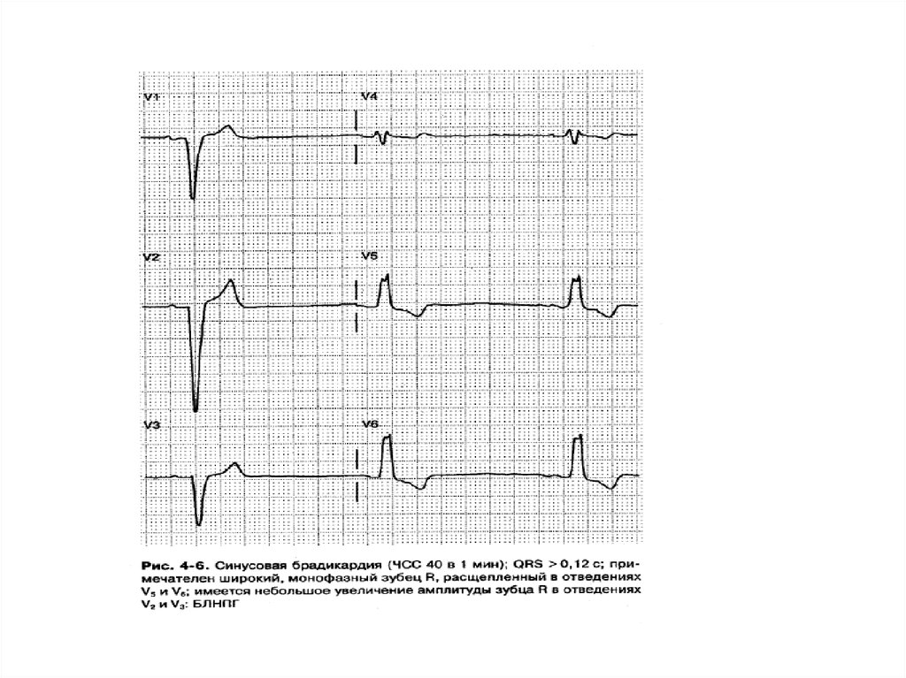 Синусовая брадикардия горизонтальная. Брадикардия без зубца р на ЭКГ. Синусовая брадикардия сердца что это у женщин.