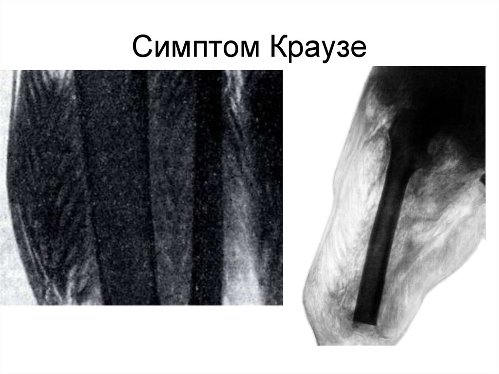 Симптом рисунок елочки