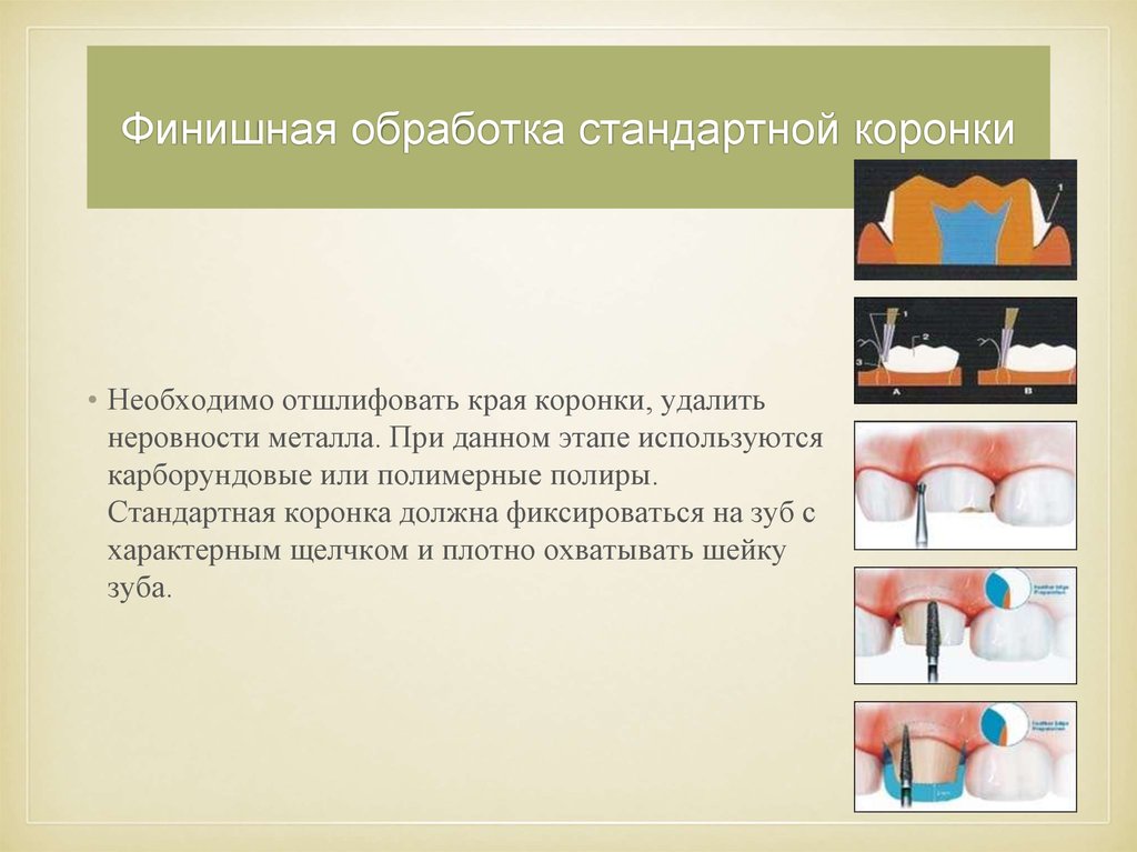 Плотный охватить. Финишная обработка зубов. Стандартные коронки. Этапы финишной обработки пломб. Финишная обработка пломбы.