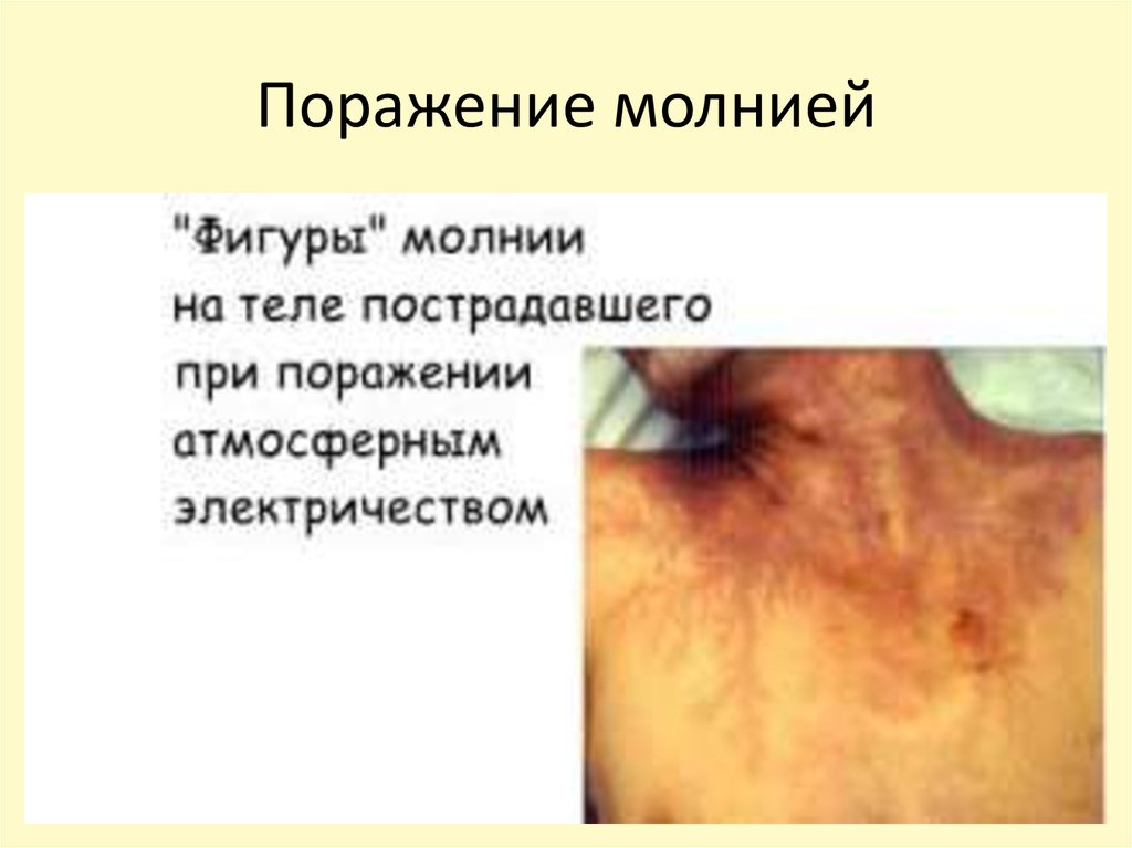 Поражение молнией