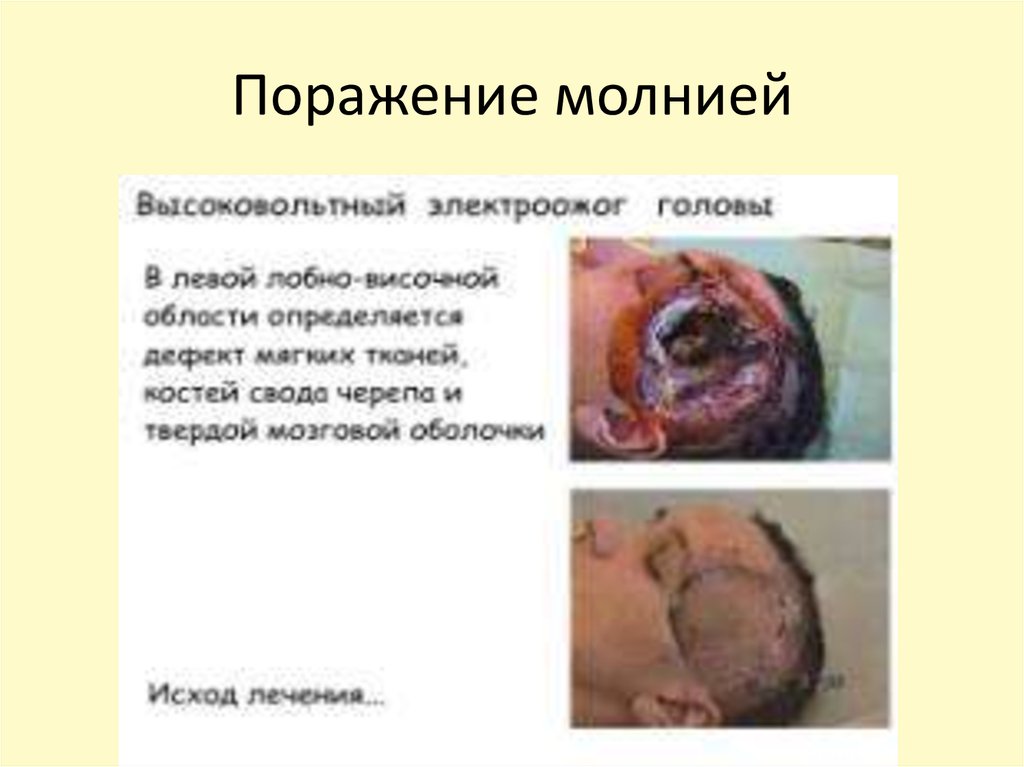 Поражение молнией