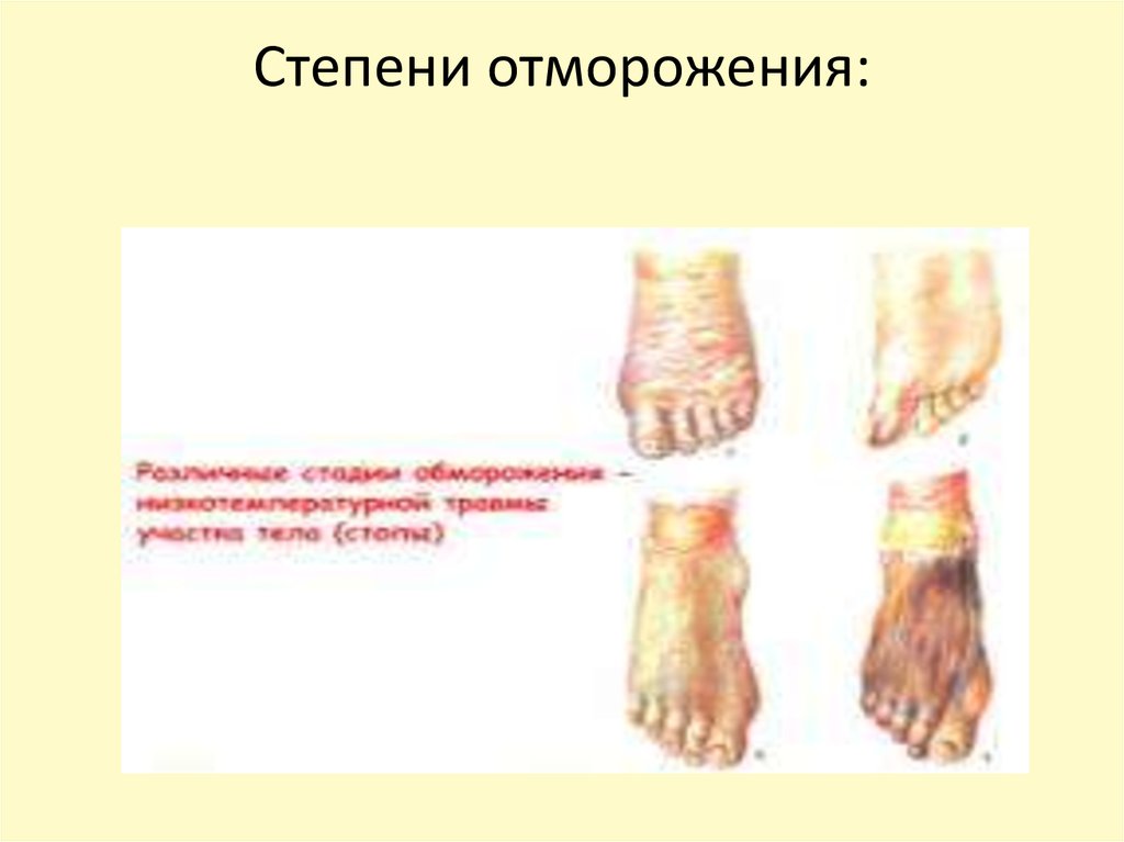 Степени отморожения:
