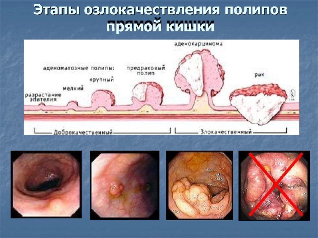 7-13 ноября - неделя профилактики рака толстой кишки | 09.11.2022 | Новости  Улан-Удэ - БезФормата