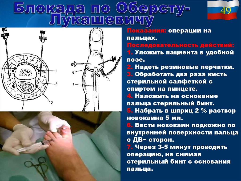 Проводниковая анестезия презентация