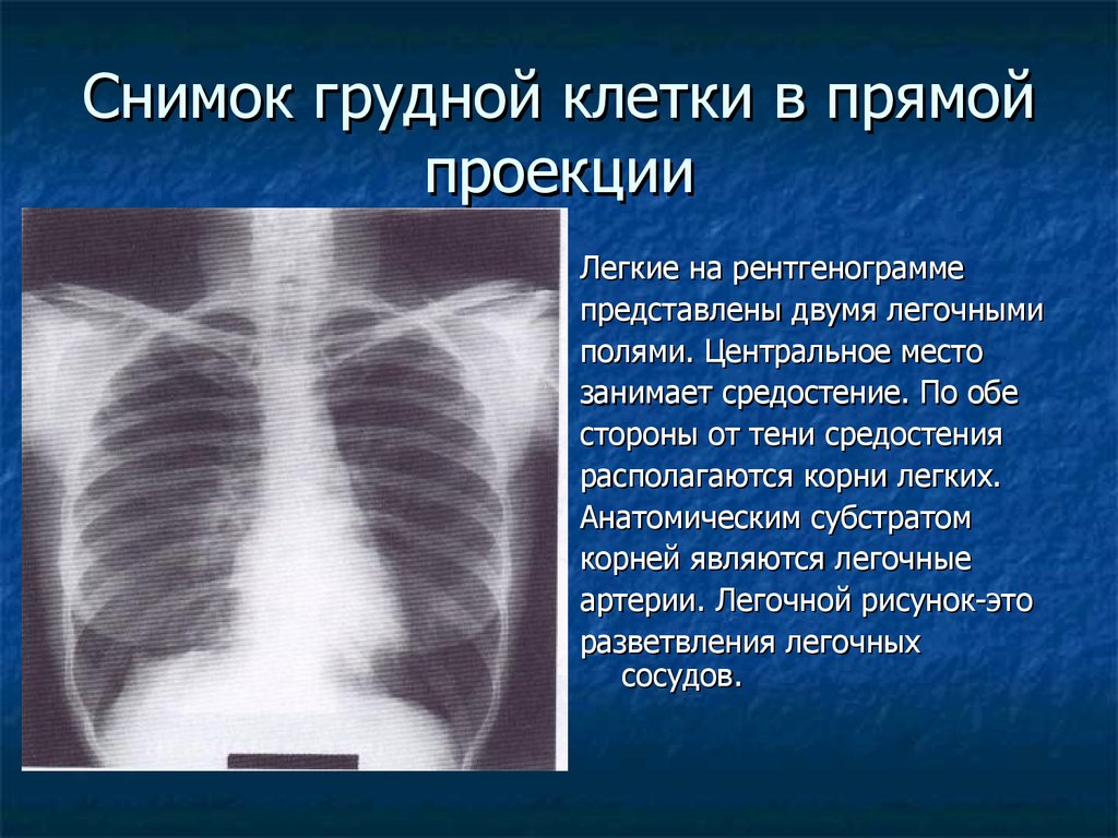 Описание рентген снимка. Норма снимка рентгена грудной клетки. Задняя проекция грудной клетки рентген. Рентген ребер грудной клетки норма. Рентгенография грудной клетки в прямой проекции.