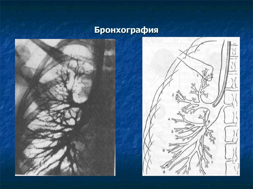 Усилен бронхиальный рисунок что это значит