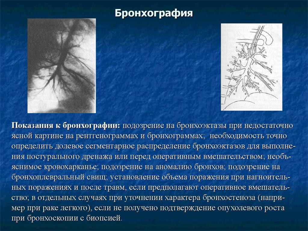 Бронхография. Бронхоскопия и бронхография. Бронхография показания. Бронхография при бронхиальной астме.