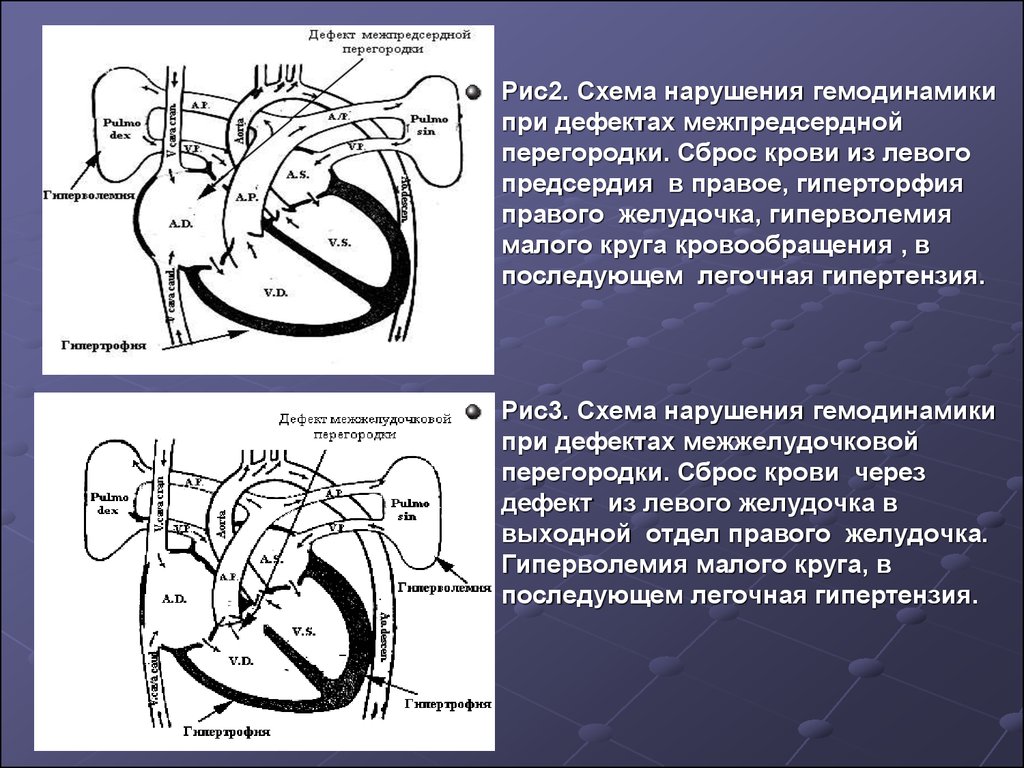 Дефект межпредсердной перегородки. Дефект межпредсердной перегородки гемодинамика. ДМПП гемодинамика. Дефект межпредсердной перегородки клиника. Гемодинамика при ДМПП.