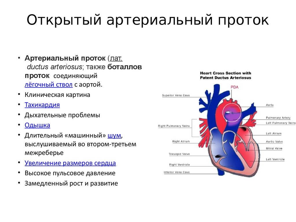 Осложнения фк. Врожденный порок сердца открытый артериальный проток. Открытый артериальный проток Баталов. Открытый артериальный проток (ОАП) - врождённый порок сердца. ВПС Баталов проток.