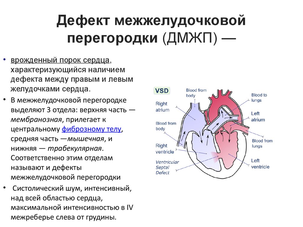 Перегородка в желудочке сердца