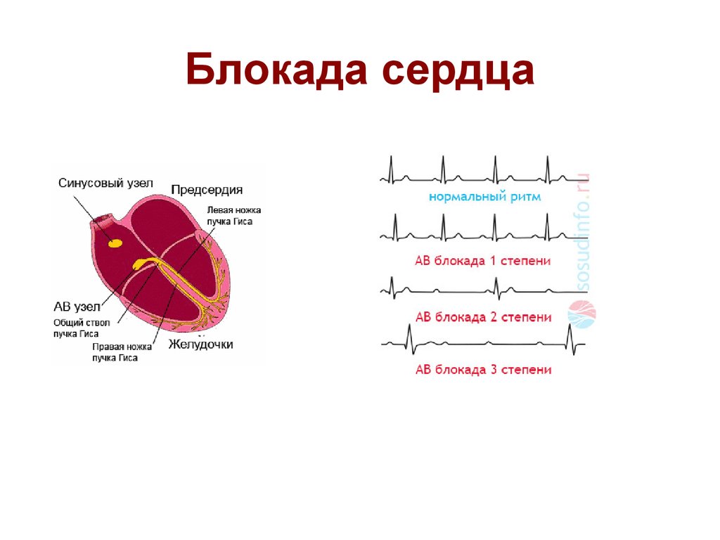 Блокада левого у сердца