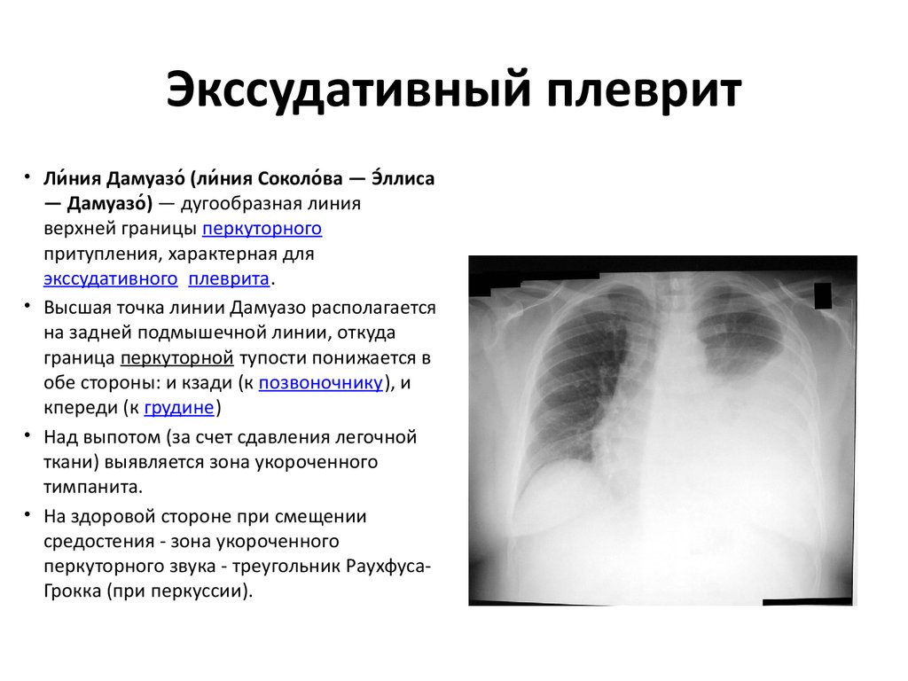 Объем гидроторакса. Рентгенологические признаки экссудативного плеврита. Плеврит рентгенограмма линия Дамуазо.