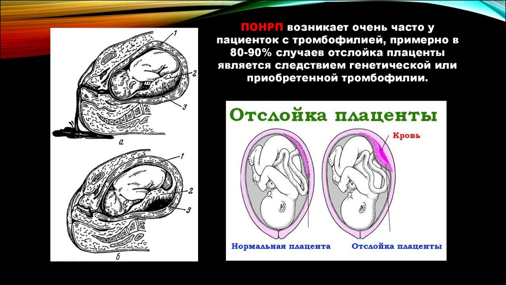 Отслойка плаценты на ранних сроках беременности. Отслойка плаценты этиология. Преждевременная отслойка нормально расположенной плаценты. Полная и частичная отслойка плаценты.