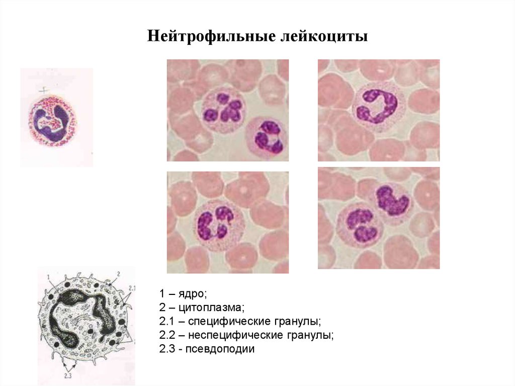 Сегмента ядерная. Сегментированные ядра лейкоцитов препарат. Полиморфно ядерный лейкоцит. Нейтрофильные лейкоциты. Нейтрофильный лейкоцитоз рисунок.