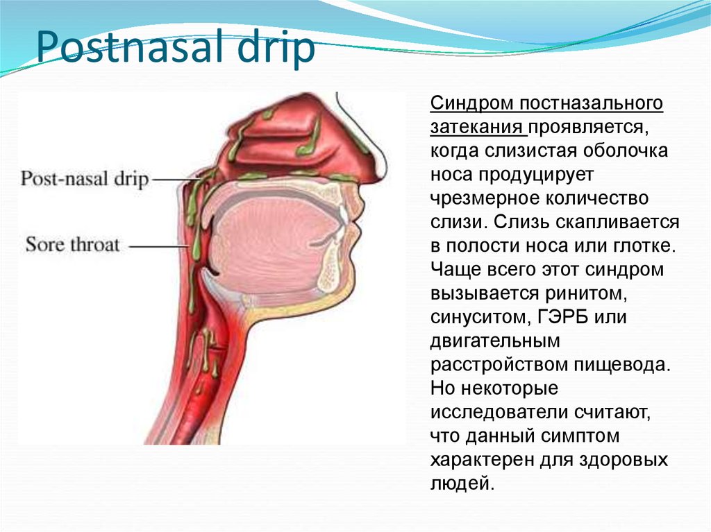 Сопли по задней стенке кашель. Ларингофарингеальный рефлюкс. Постназальный затек синдром. Ларенго фаренгиальный рефлюкс.