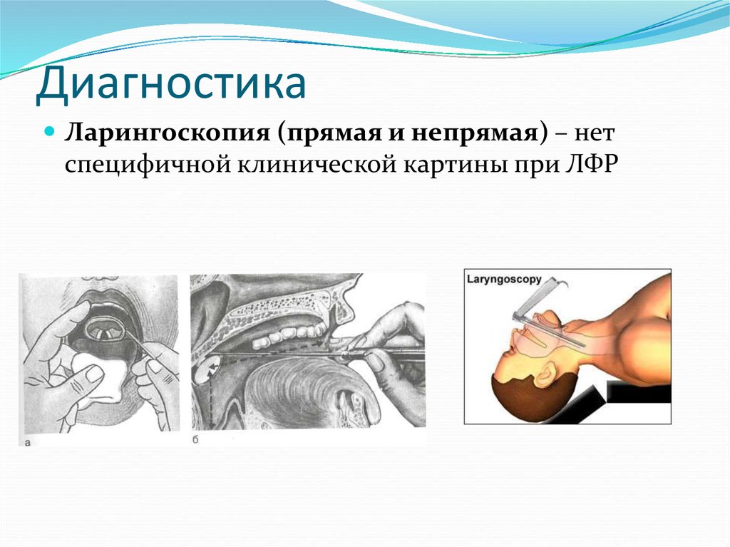 Ларингоскопия это