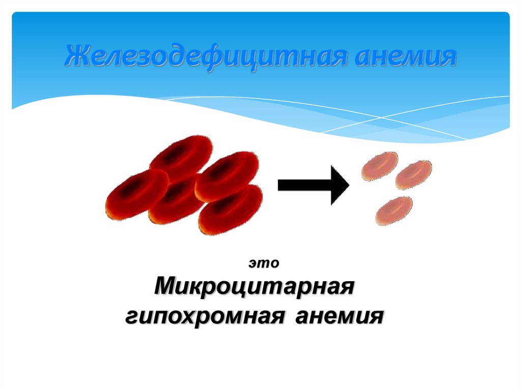 Группы железодефицитной анемии. Железодефицитная анемия микроцитарная. Железодефицитная анемия гипохромная. Железодефицитная анемия у детей.
