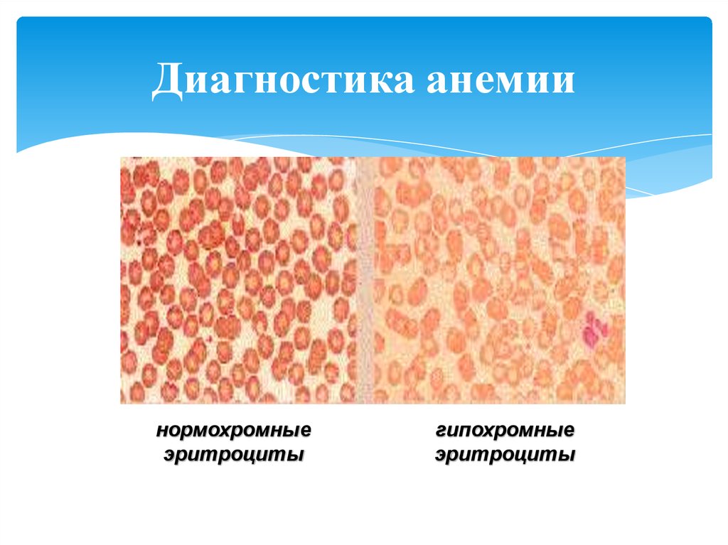 Нормохромная гипохромная анемия. Железодефицитная анемия гипохромная. Гипохромная и гиперхромная анемия. Гипо и гиперхромная анемия. Гипохромная анемия эритроциты.