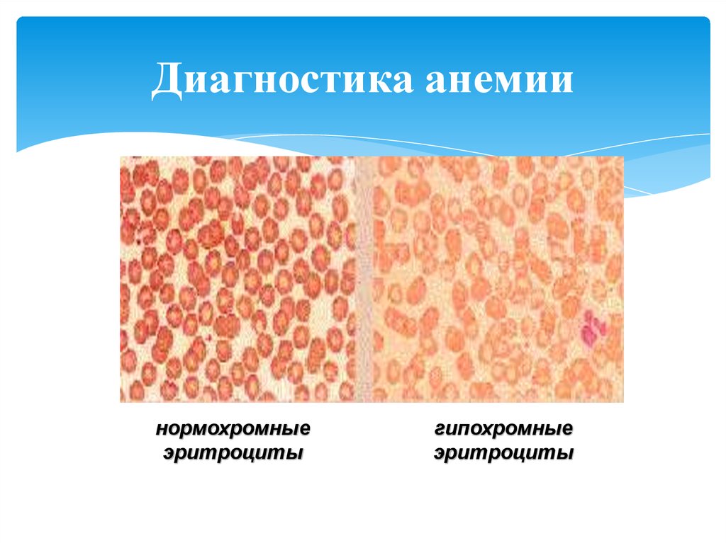 Железодефицитная анемия у детей презентация