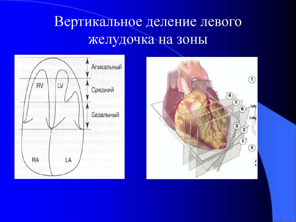 Сократимость лж. Зоны левого желудочка ЭХОКГ. Сегменты левого желудочка на ЭХОКГ. Сегменты левого желудочка сердца. Оценка локальной сократимости миокарда левого желудочка.
