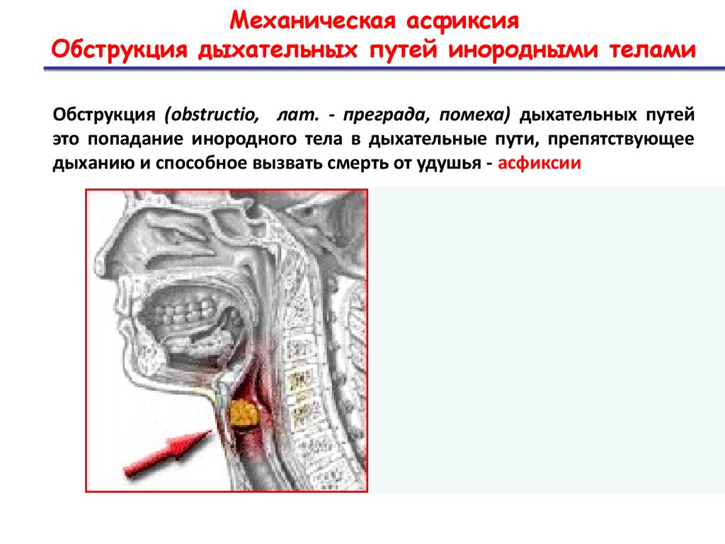 Обструкция дыхательных путей. Причины закупорки дыхательных путей. Обтурации верхних дыхательных путей. Обструкция верхних дыхательных путей инородным телом. Механическая обтурация дыхательных путей.