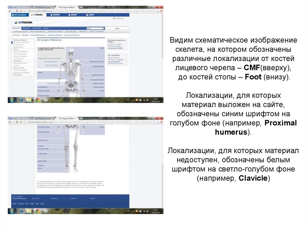 Видим схематическое изображение скелета, на котором обозначены различные локализации от костей лицевого черепа – CMF(вверху), до костей сто