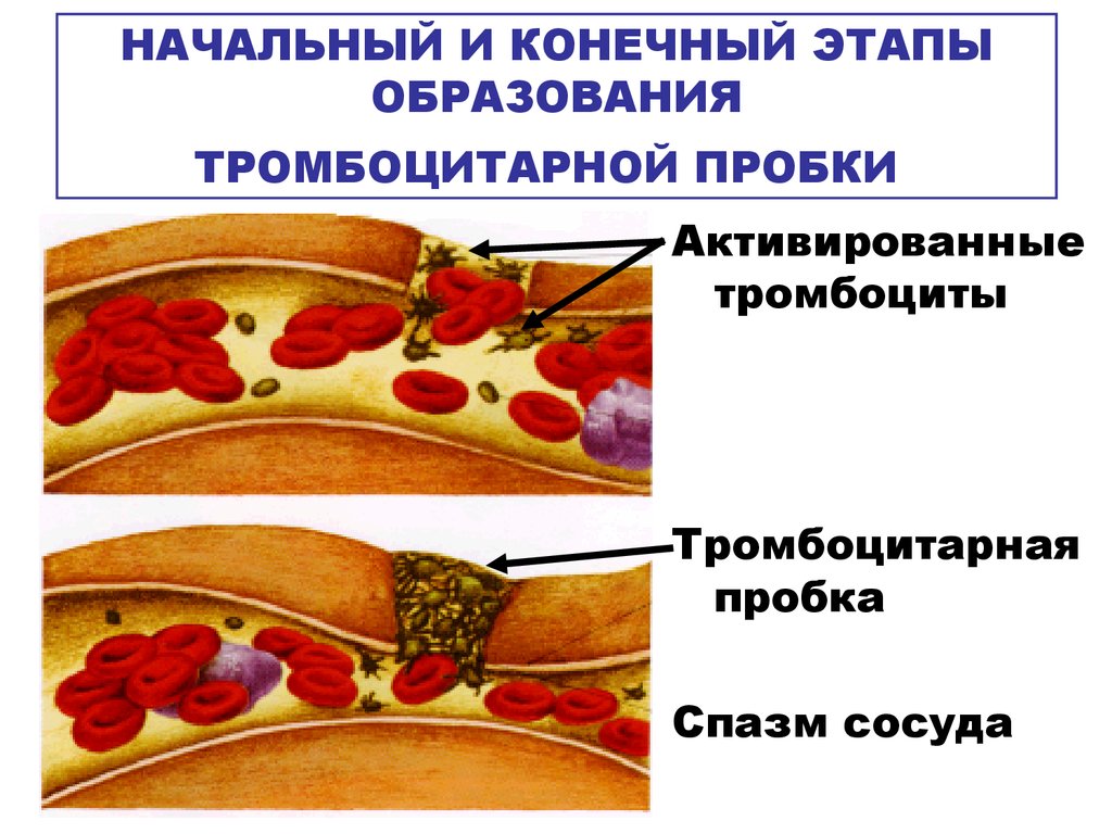 Тромбоциты при кровотечении. Тромбоцитарная пробка. Механизм формирования тромбоцитарной пробки. Схема образования тромба. Этапы образования тромбоцитарного тромба.
