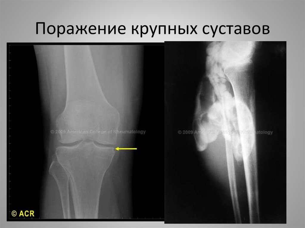 Большим поражением. Ревматоидный артрит крупных суставов. Поражение крупных суставов. Поражение одного крупного сустава. Поражение крупных суставов артрит.