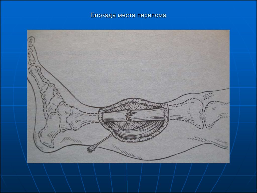 Блокады при переломах. Новокаиновые блокады перелом ребер. Межреберная новокаиновая блокада. Новокаиновая блокада места перелома. Блокада места перелома ребер.