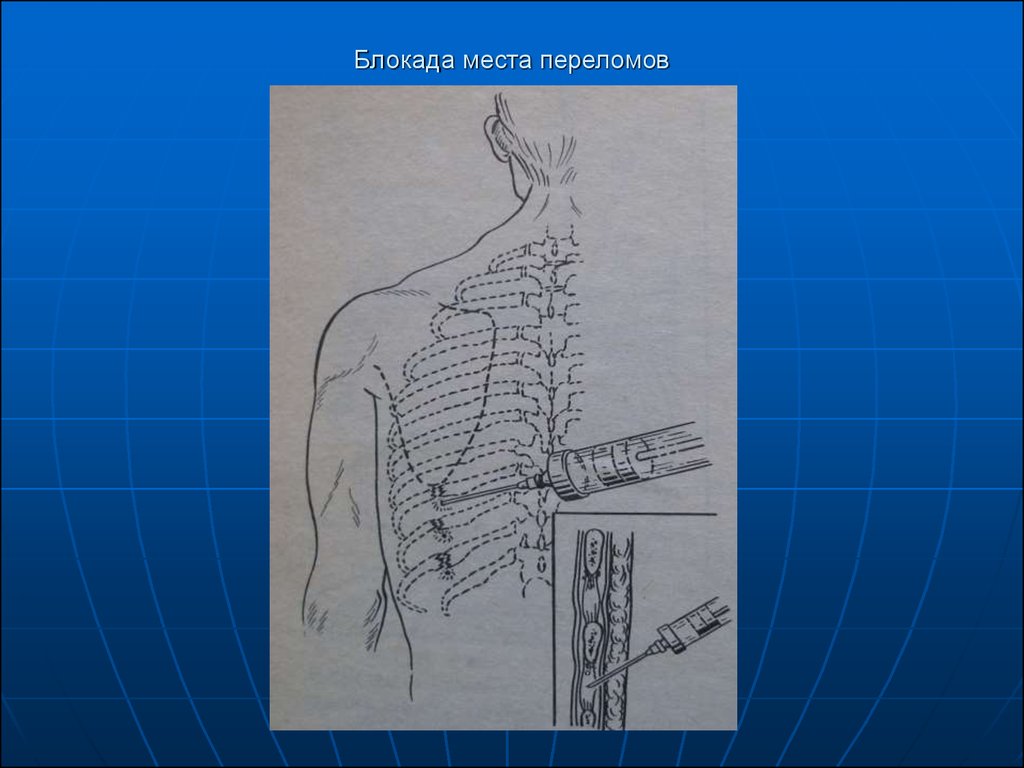 Блокады при переломах. Блокада места перелома ребер. Блокада места перелома показания. Местная анестезия перелома. Блокада мест переломов длинных костей.