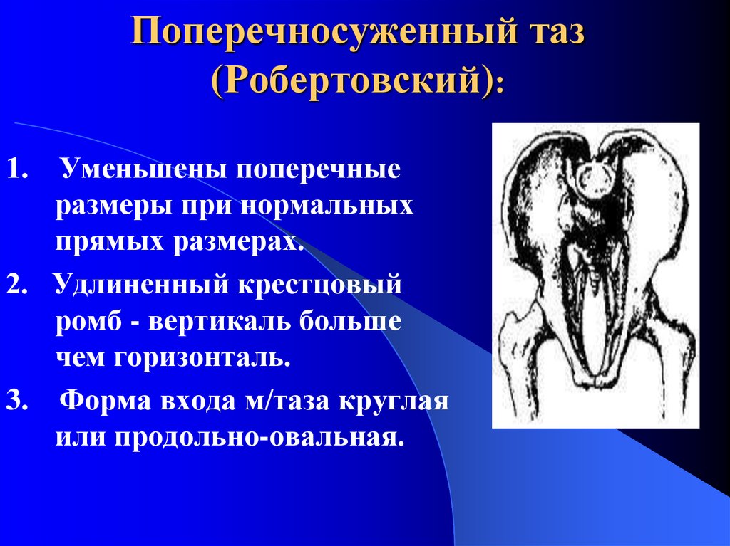 Аномалии таза презентация