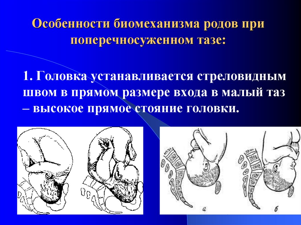 Механизм родов при поперечносуженном тазе. Поперечносуженный таз биомеханизм родов. Биомеханизм родов при узком тазе. Биомеханизм родов при поперечносуженном узком тазе..