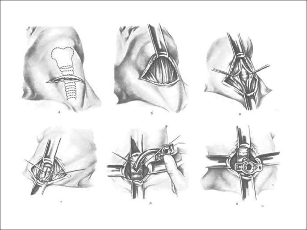 Графические операции. Трахеостомия по Джексону и дилатационная. Трахеостомия топографическая анатомия этапы. Трахеостомия методика операции.