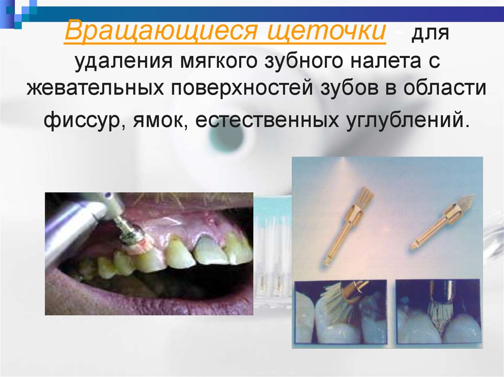 Вращающиеся щеточки - для удаления мягкого зубного налета с жевательных поверхностей зубов в области фиссур, ямок, естественных углублени
