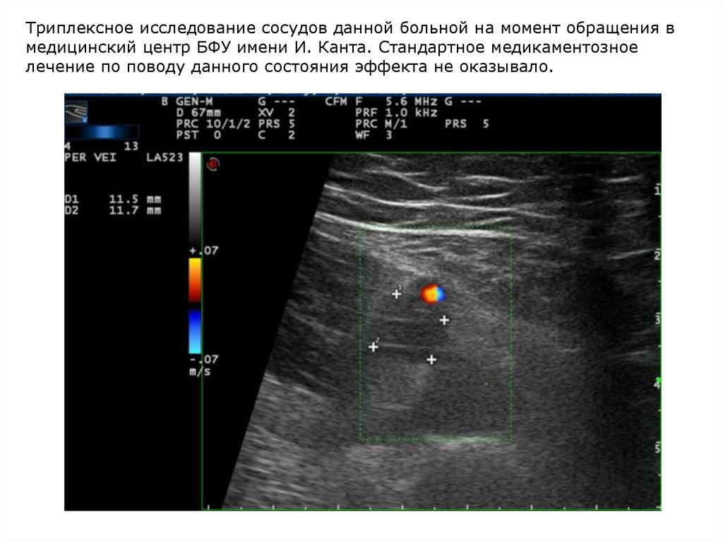 Исследование сосудов. Ультразвуковое триплексное сканирование. Триплексное исследование сосудов. Триплексное УЗИ сосудов. Дуплексное, триплексное исследование сосудов.