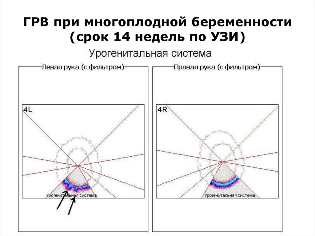 Грв. Метод грв. Коротков газоразрядная визуализация метод грв. Грв камера. Разрешение грв.