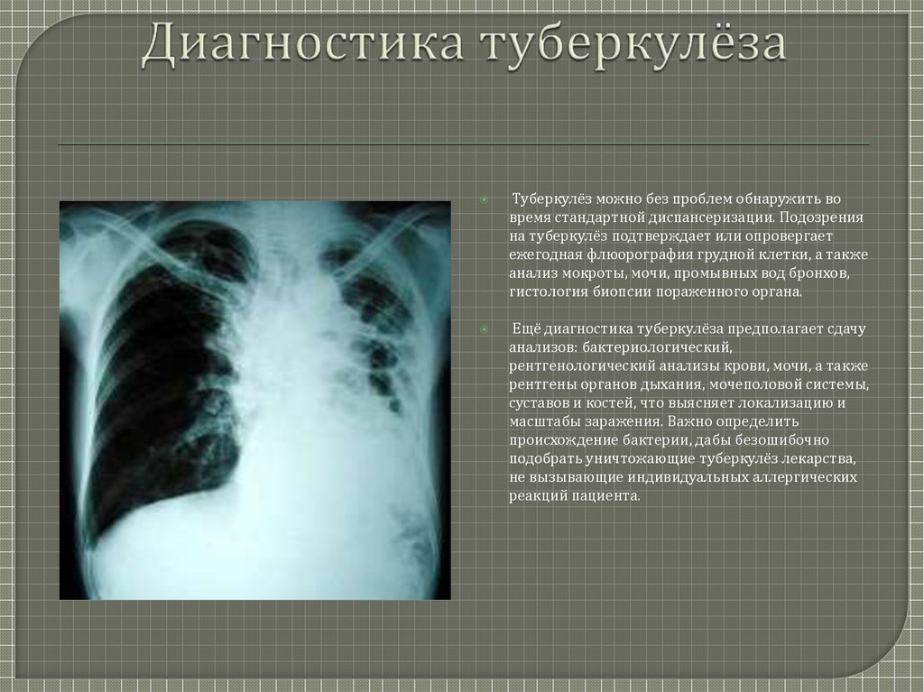 Врожденный туберкулез. Подозрение на туберкулез. Диагноз туберкулез. Начальная стадия туберкулеза.