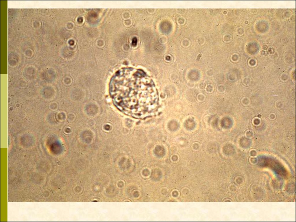 Микроскопическое исследование предстательной железы. Амилоидные тельца спермограмма. Макрофаги спермограмма микроскопия. Амилоидные тельца микроскопия. Лецитиновые зерна микроскопия.