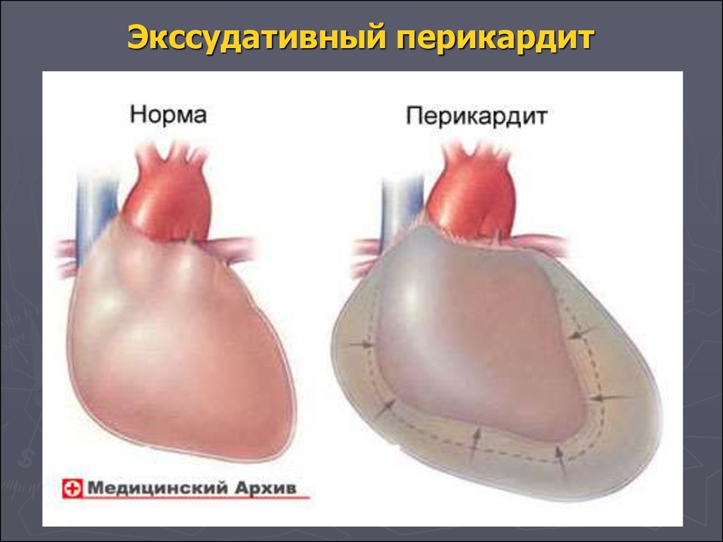 Перикард что это простыми словами. Гидроперикард и экссудативный перикардит. Что такое перикардит сердца симптомы. Воспаление околосердечной сумки.