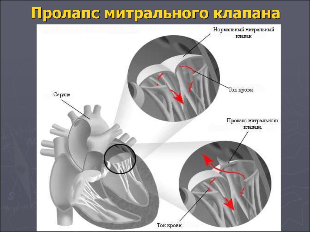 Пролапс митрального клапана категория