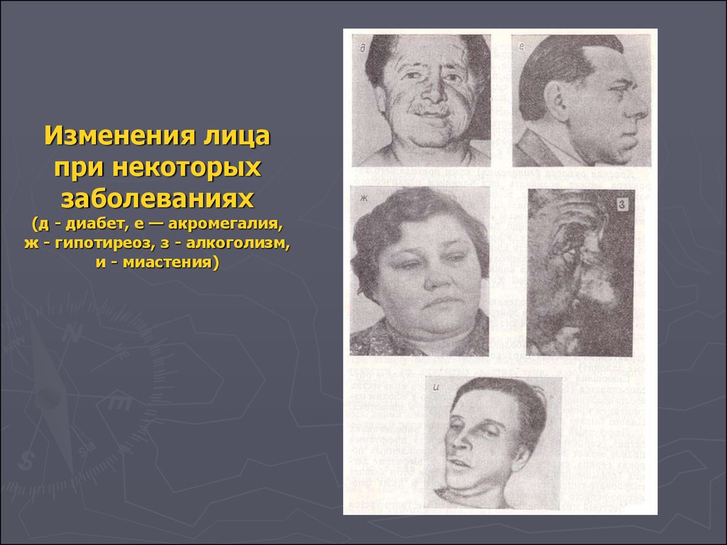 У некоторых больных заболевание. Акромегалия акромегалия. Лицо больного при акромегалии. Акромегалия и гипотиреоз. Изменение лица при акромегалии.