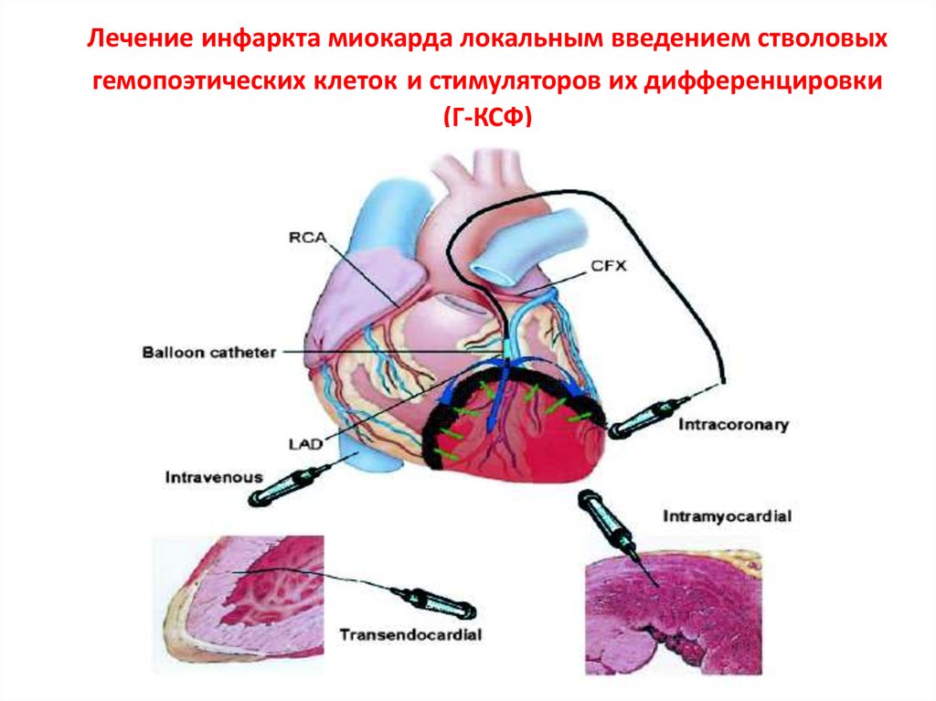 Инфаркт терапия. Терапия инфаркта миокарда. Клеточная терапия миокарда. Стволовой инфаркт миокарда. Инфаркт миокарда регенерация.