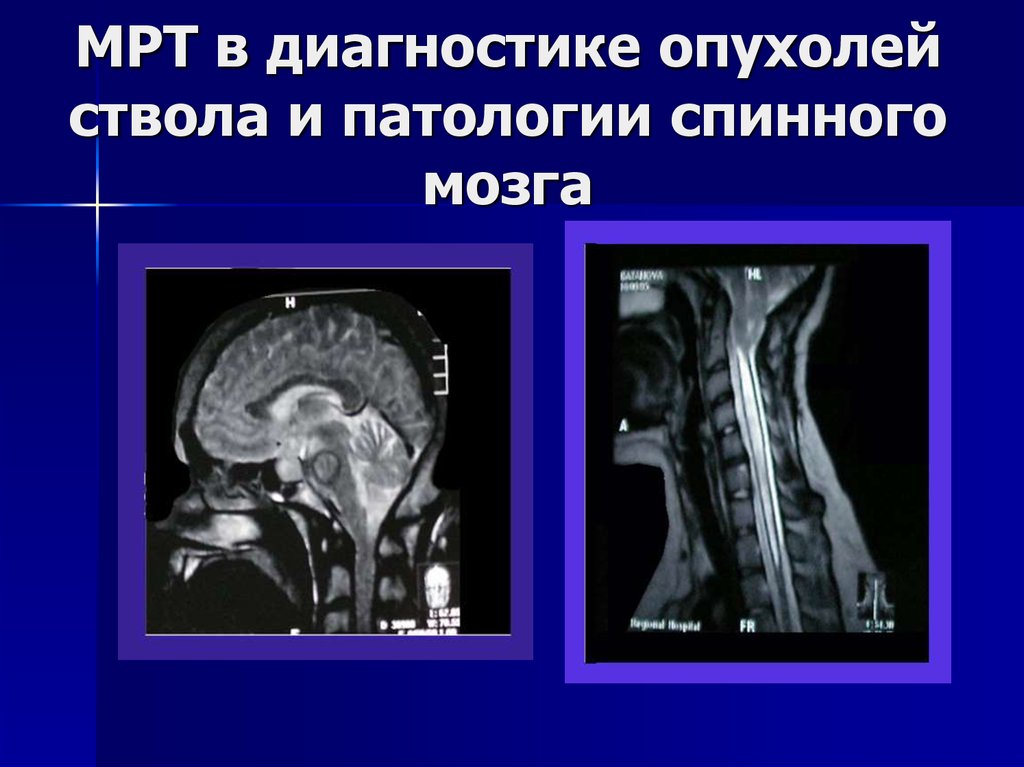 Диагностика опухолей головного мозга презентация