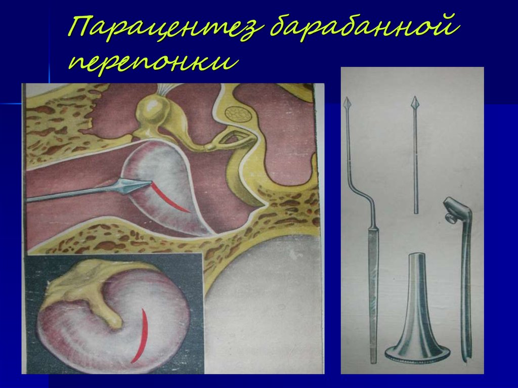 Перфорация барабанной перепонки фото