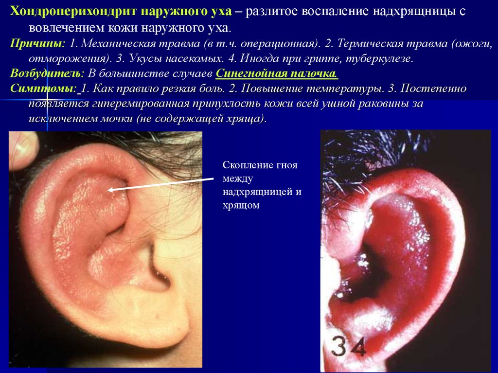 Холестеатома среднего уха фото