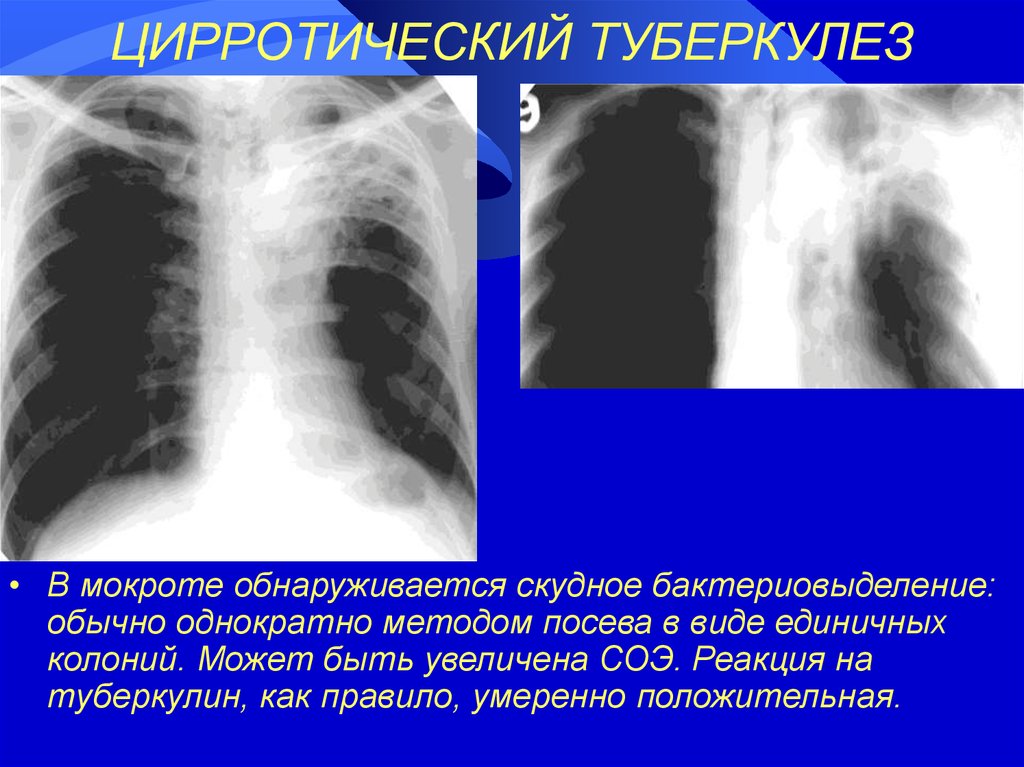 Как сделать туберкулез