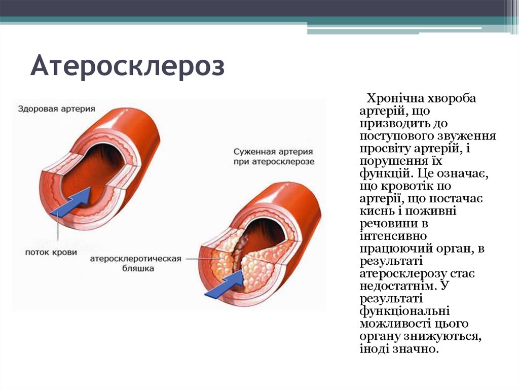 Инвалидность при атеросклерозе. Инвалидность по атеросклерозу сосудов. Атеросклеротическая бляшка. Инвалидность при атеросклерозе сосудов. Из чего состоит атеросклеротическая бляшка.